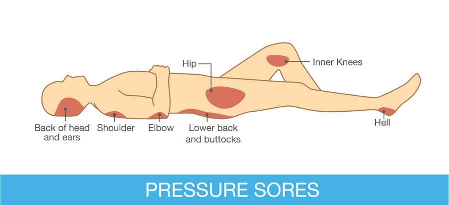 Pressurepoints for bed-bound patients